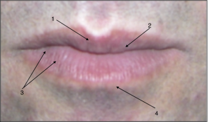 around mouth skin lips uneven pigmentation