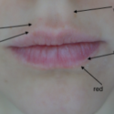 White Line Around the Lips
