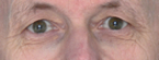 Blue/black skin at inner eye corners and under eyes