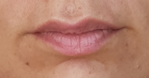 The puffy, pink ledge that extends beyond the bottom lip border indicates leaky gut.