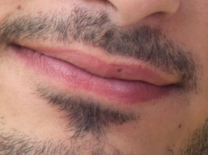 Photo showing a defined border between the bottom lip and skin, and normal skin and lips that are free of color, size and texture irregularities.
