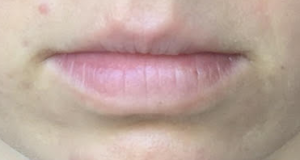 34-year-old Australian woman. The entire lower lip border is white; below the white there is a swollen, pinkish “ledge.” The lack of uniform size and color of her lips indicates additional gastrointestinal issues.
