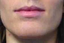 Chin crease forming on a 31-year-old woman with depleated kidney energy. 