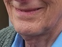 No chin crease on this 83-year-old man who has maintained his kidney energy.
