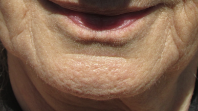 71-year-old woman who has developed a chin crease due to aging and kidney depletion.