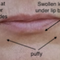 Enhance Your Lip Appearance — with Before and After Photos