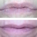 Wrinkled Lips Indicate Gut Problems—with Before and After Photos